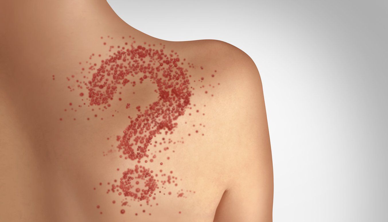 Measles Is Baaaack. Are You At Risk?