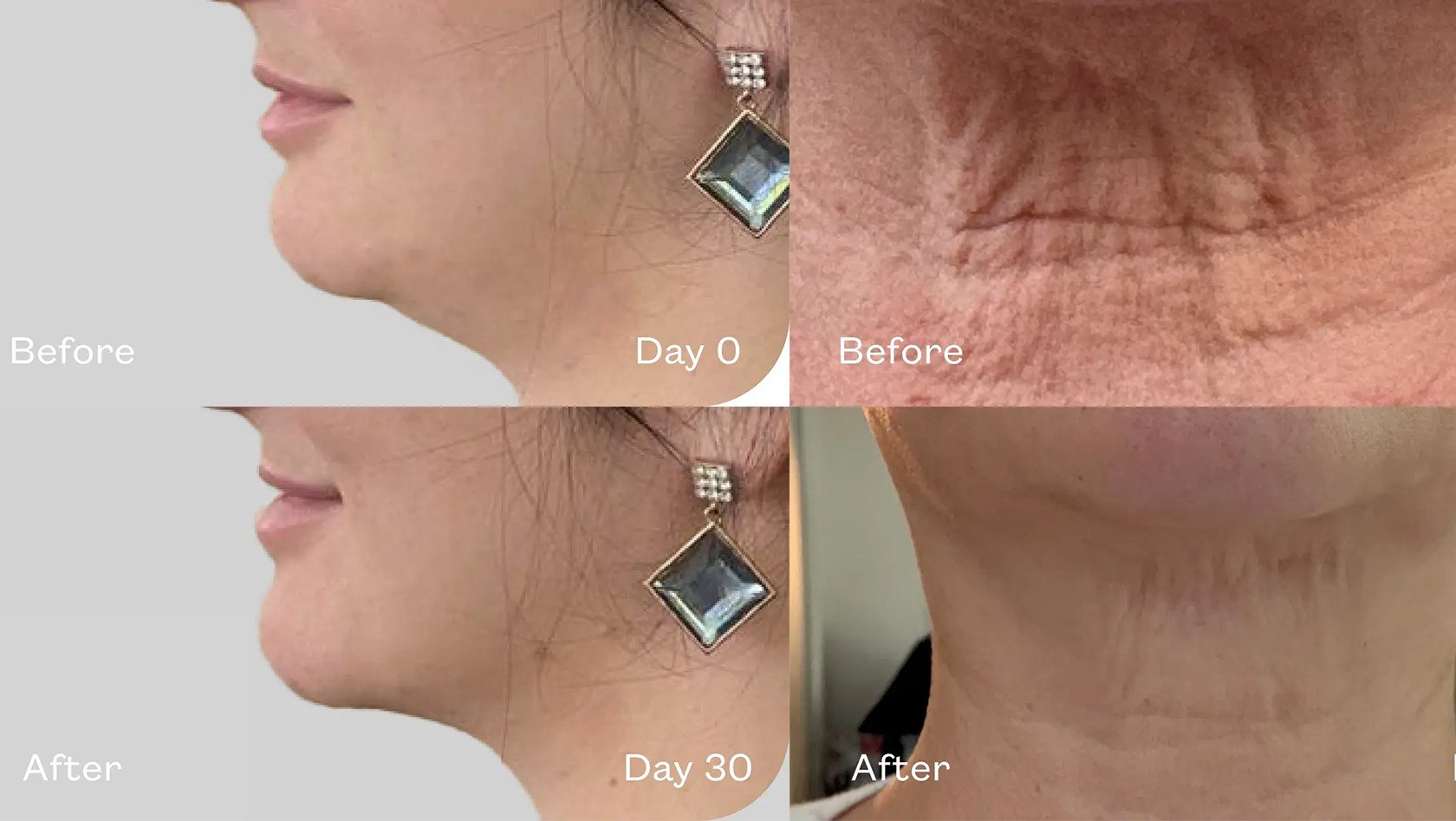 Sagging Jowls? This Serum Sculpts the Jawline and the Neck in Days