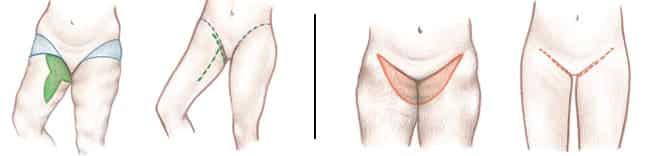 Is a Thigh Lift Worth It?