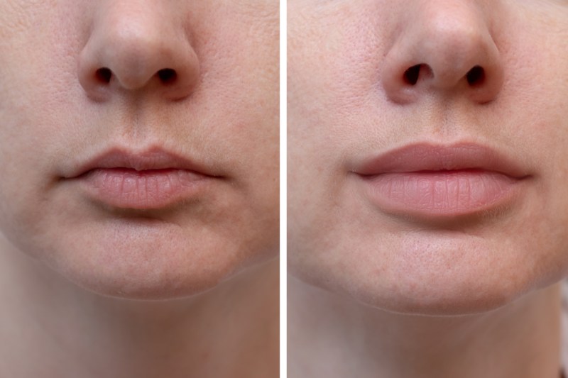 Want Fuller Lips? Here’s How to Get Them.