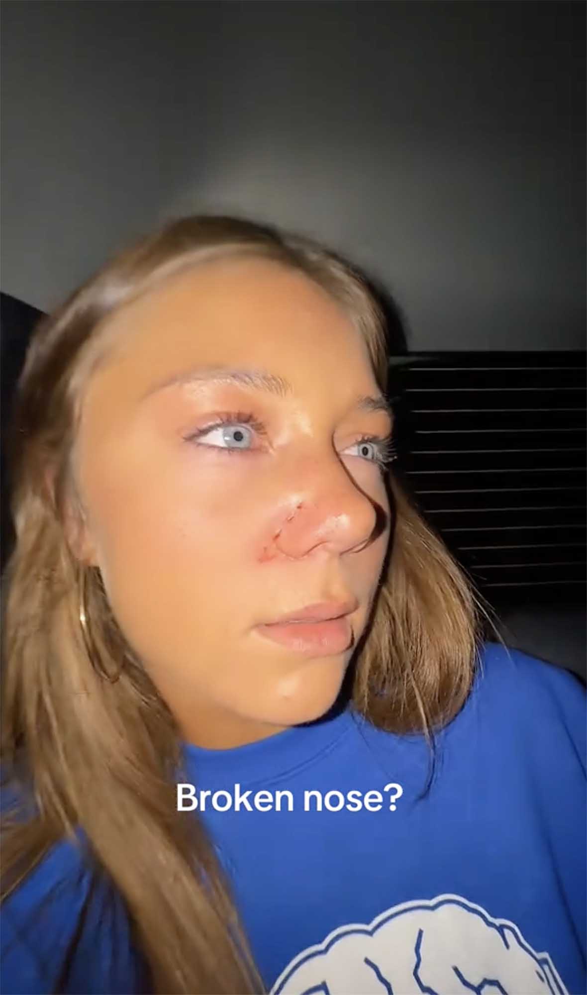 DWTS’ Hailey Bills Reveals Possible Broken Nose After Wild Thanksgiving Game