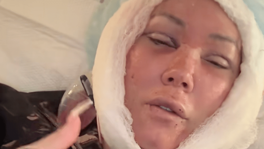 Jelly Roll's Wife Bunnie Xo Reveals Gruesome Aftermath of Her Facelift